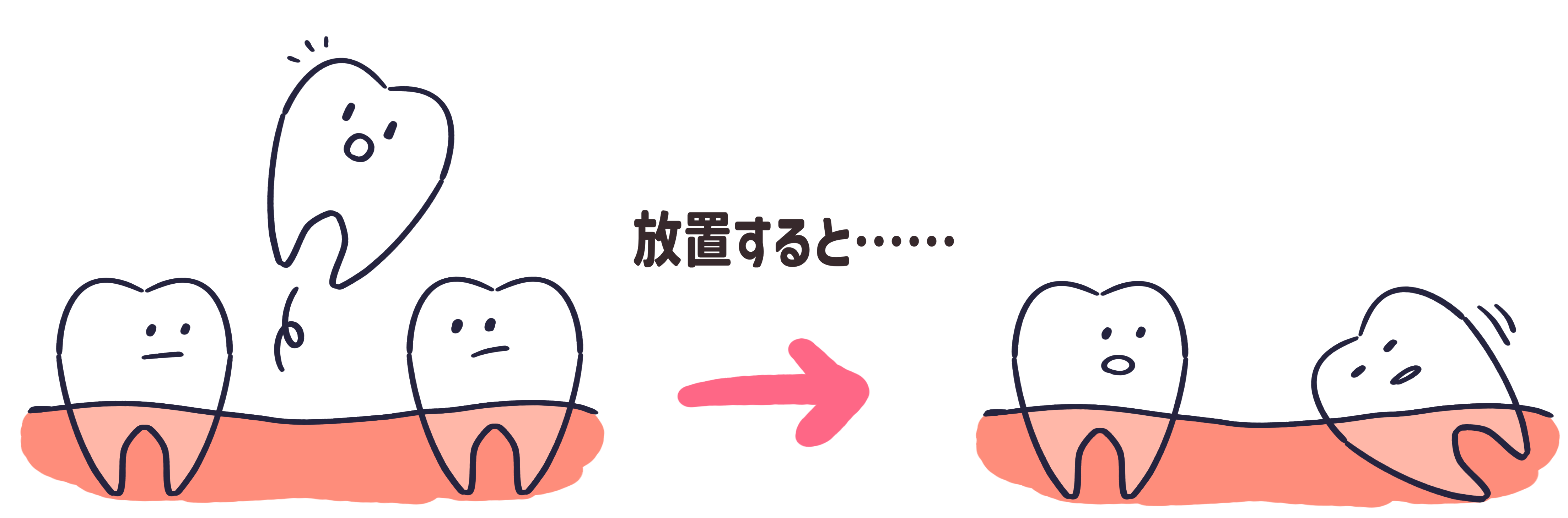 奥歯が抜けて放置すると、奥歯が傾いていくイラスト
